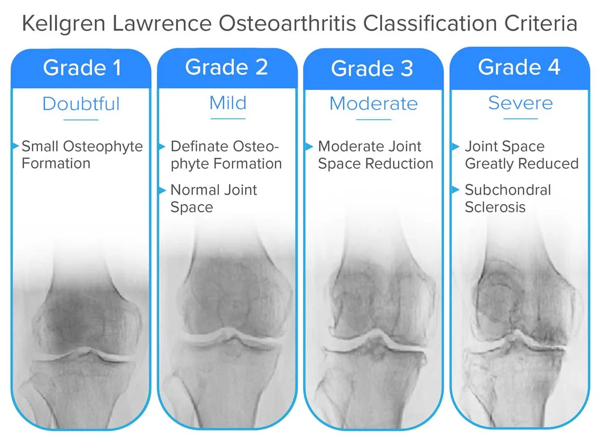 Osteoarthritis Grade Classifications