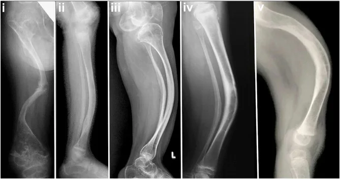 Osteogenesis Imperfecta
