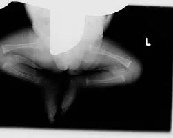 Osteopenia Of Prematurity