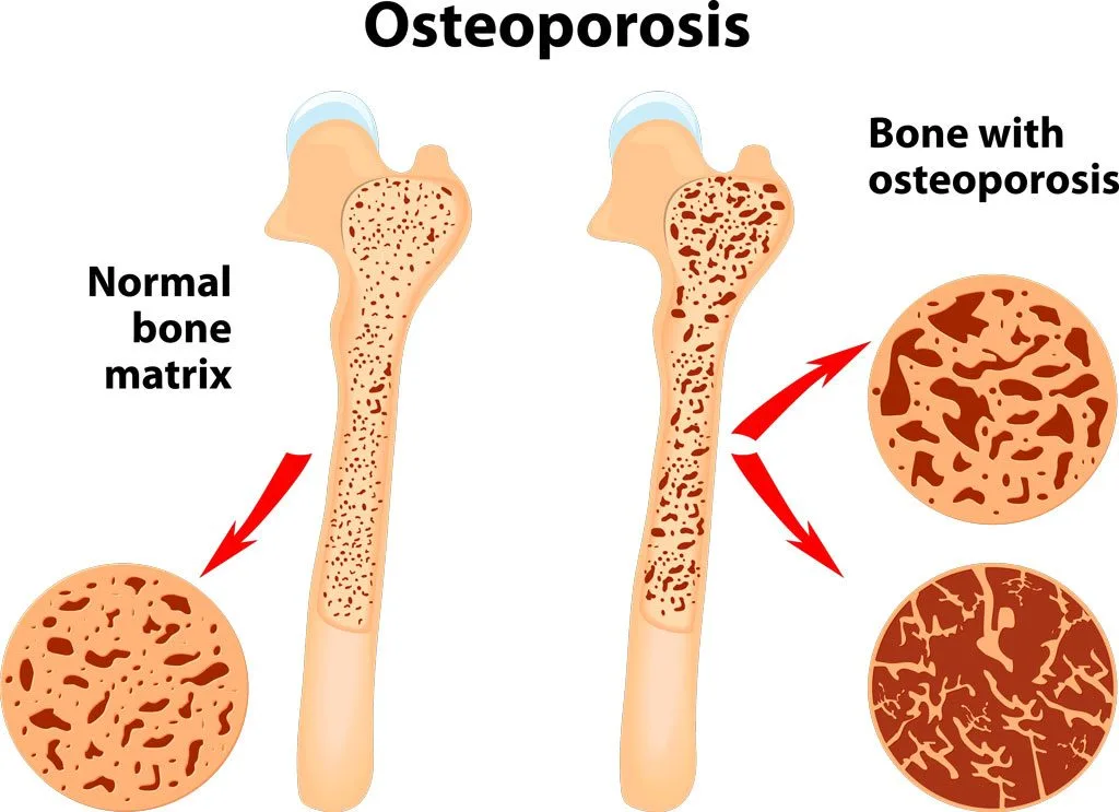 Osteoporosis