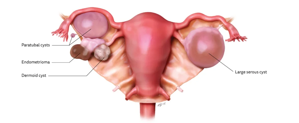 Ovarian Cysts E1733385022441