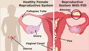 PELVIC INFLAMMATORY DISEASES PID 1