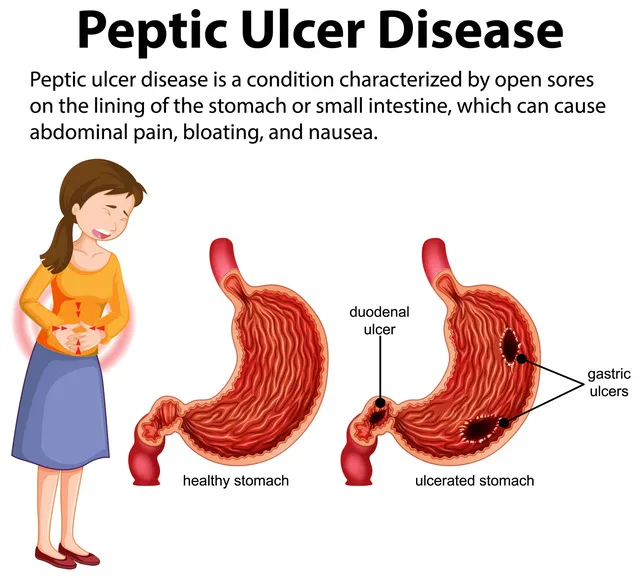 PEPTIC ULCER DISEASE PUD