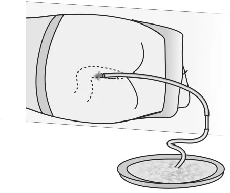 Passing A Flatus Tube