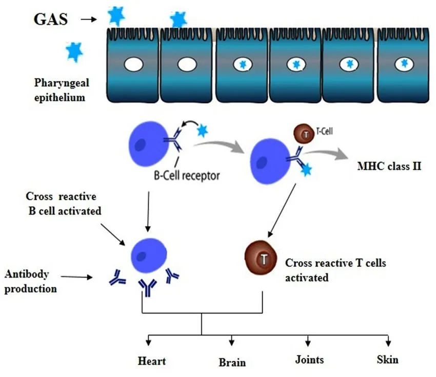 Pathophysiology Of Acute Rheumatic Fever