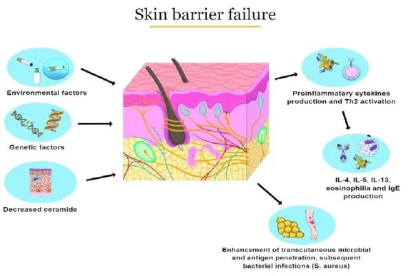 Pathophysiology Of Atopic Dermatitis E1707835058865