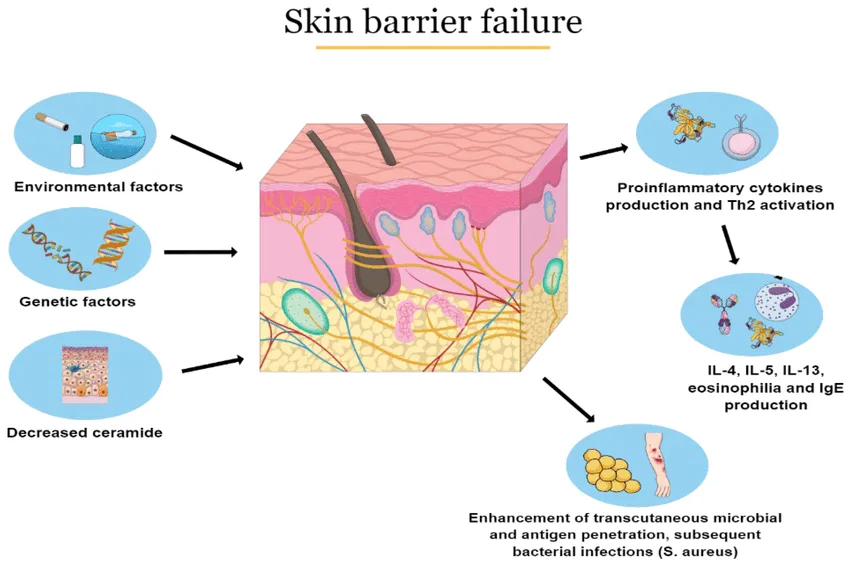 Pathophysiology Of Atopic Dermatitis 1
