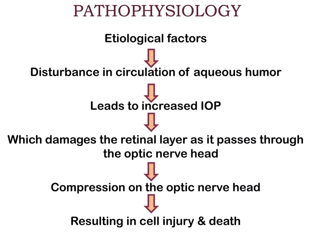 Pathophysiology Of Glaucoma 1 E1708185701176