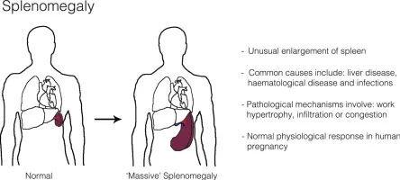 Pathophysiology Of Hypersplenism