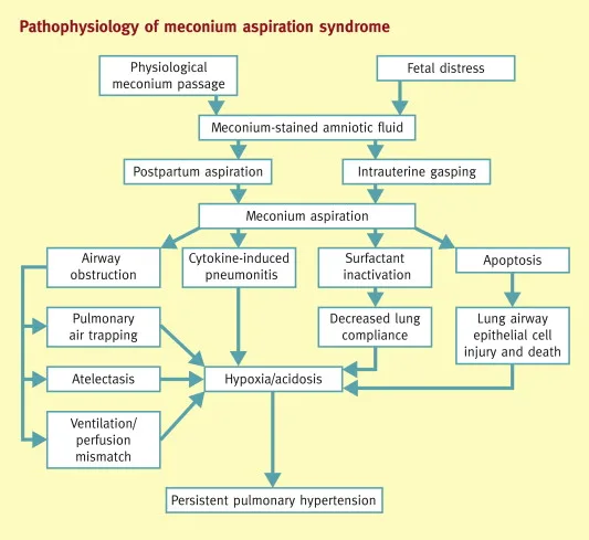 Pathophysiology Of Meconium Aspiration Syndrome