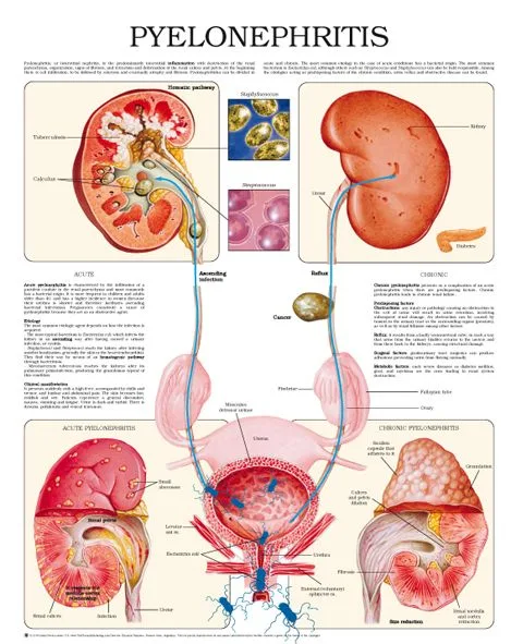 Pathophysiology Of Pyelonephritiss