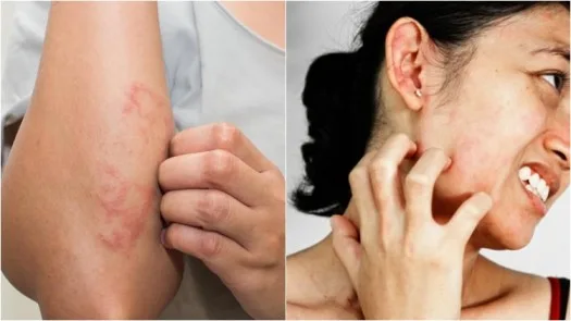 Pathophysiology Of Skin Allergies 1