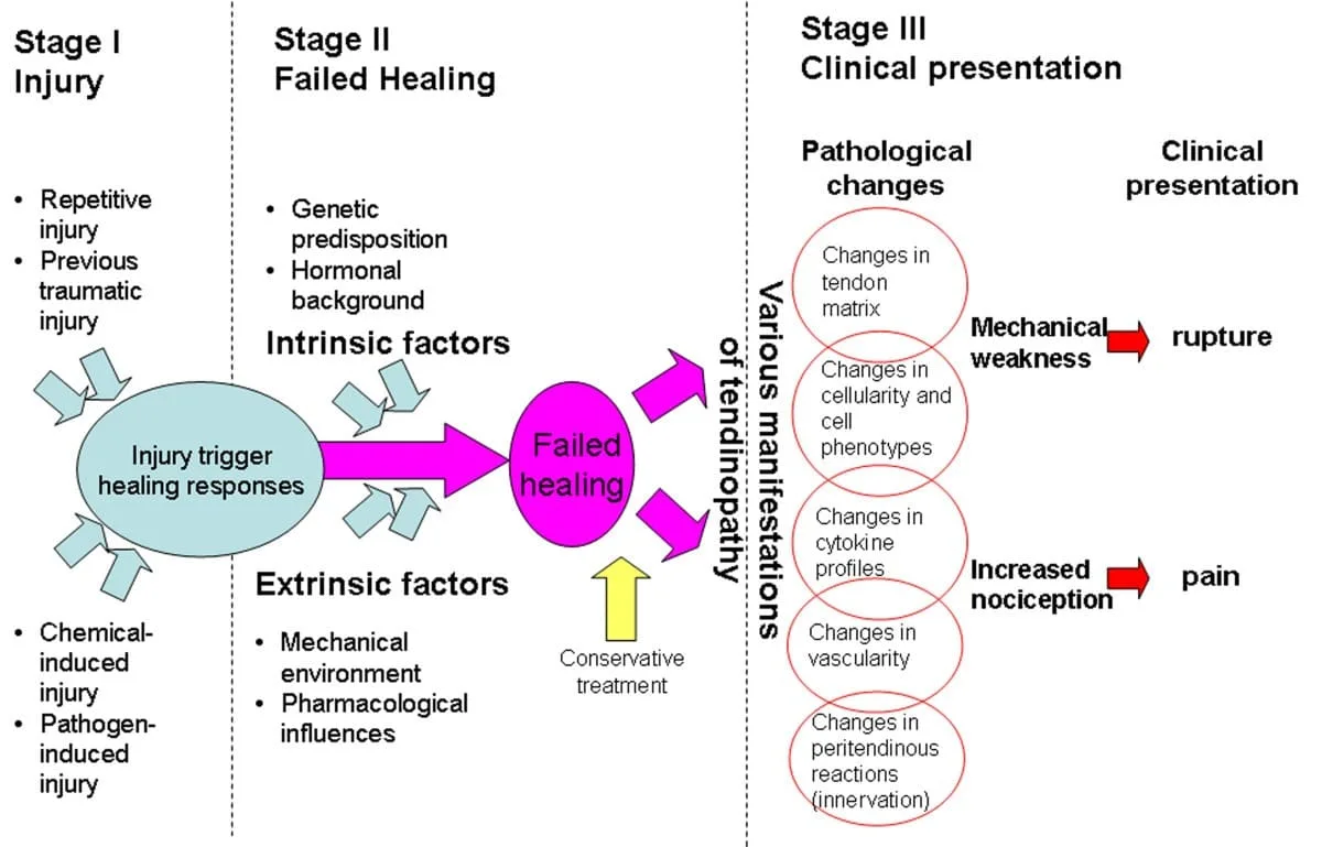 Pathophysiology Of Tendonitis 1