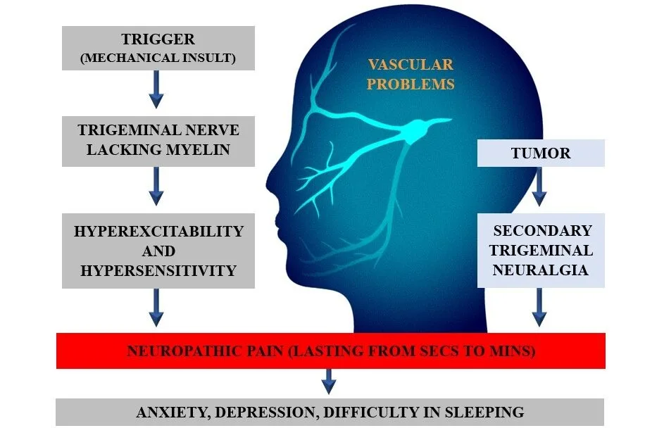 Pathophysiology Of Trigeminal Neuralgia E1742398568424