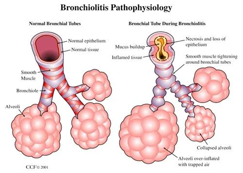 Pathophysiology Of Bronchitis