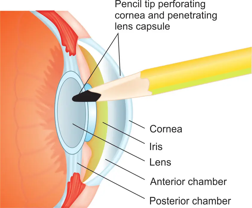 Penetrating Eye Trauma