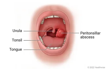Peritonsillar Abscess