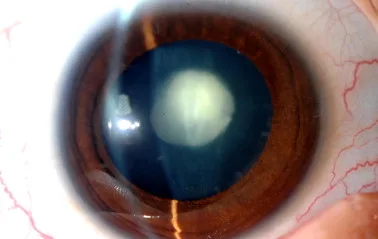 Polar Cataract