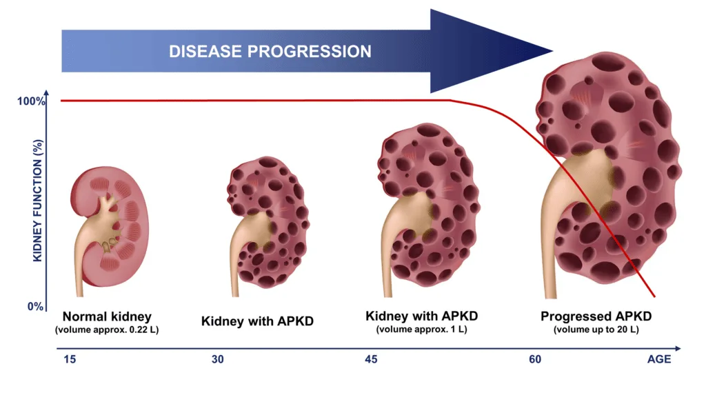 Polycystic Kidney Disease PKD 1