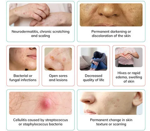 Potential Complications Of Dermatitis E1768715144593