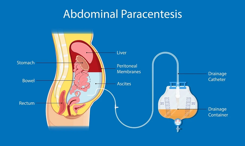 Prepare For Abdominis Paracentesis Abdominal Tapping