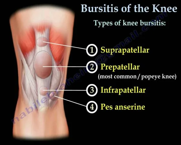 Prepatellar Bursitis