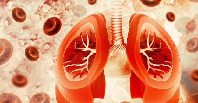 Pulmonary Hemorrhage