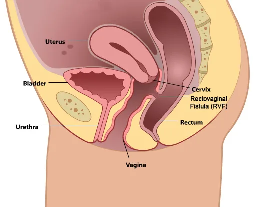 RECTO VAGINAL FISTULA