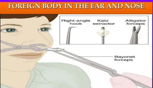 Removal Of Foreign Bodies From The Ear And Nose E1732605509780