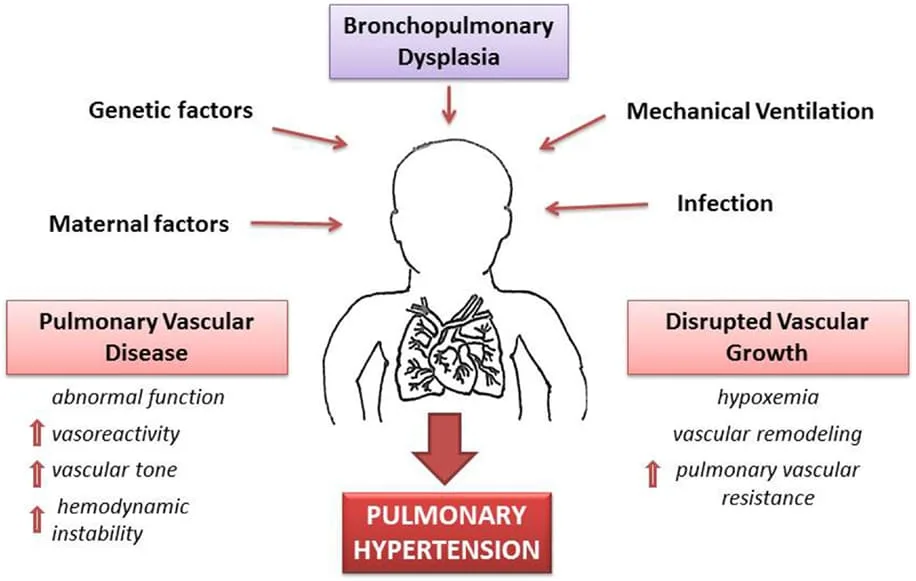 Risk Factors For Bronchopulmonary Dysplasia BPD 1