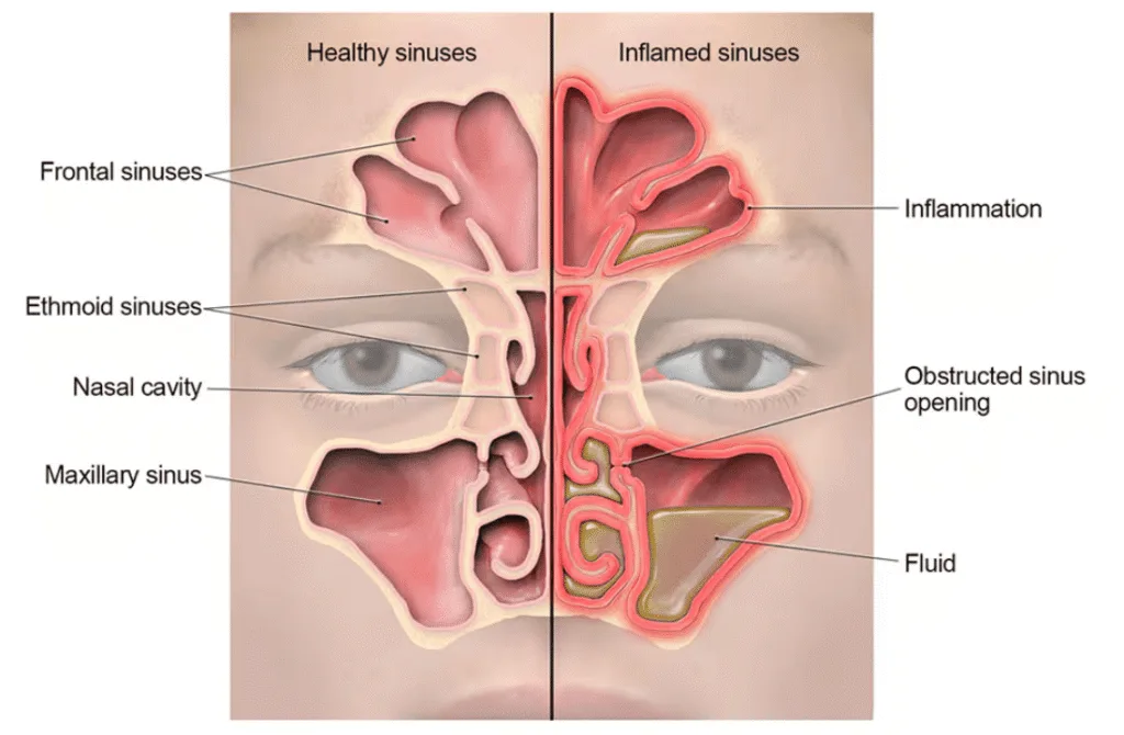 SINUSITIS RHINOSINUSITIS 1