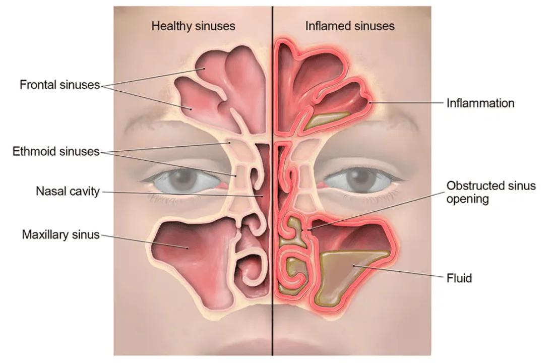 SINUSITIS RHINOSINUSITIS 1