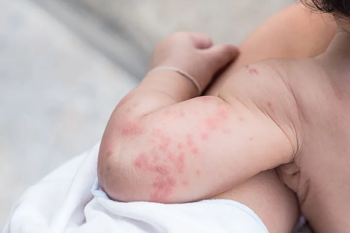 SKIN ALLERGIES Q