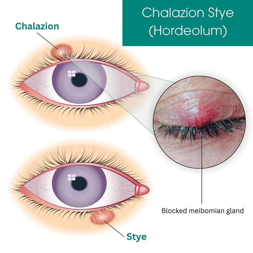 STYE HORDEOLUM 1