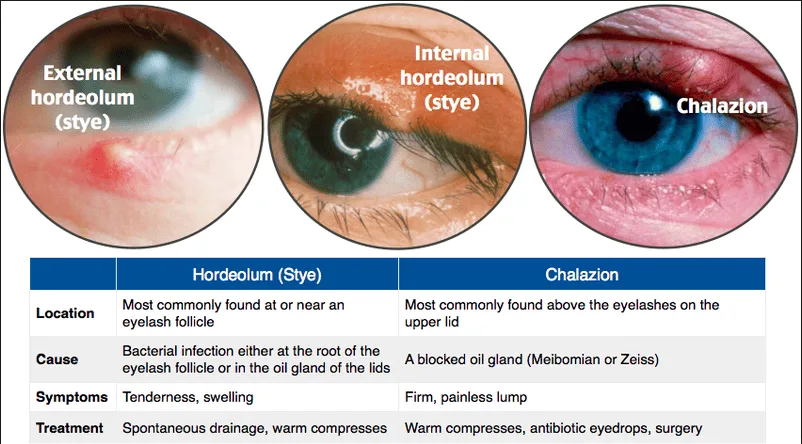 STYE HORDEOLUM Types Internal Stye And External Stye 1