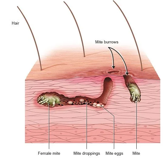 Scabies