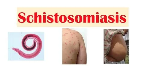 Schistosomiasis E1736827124432