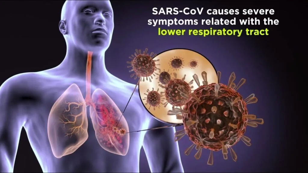 Severe Acute Respiratory Syndrome SARS 1