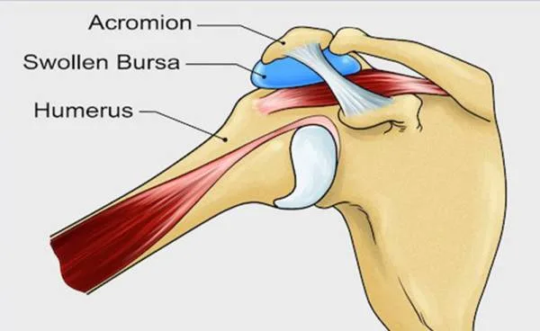 Shoulder Bursitis