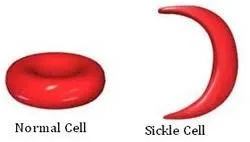 Sickle Cell Disease Sickle Shape