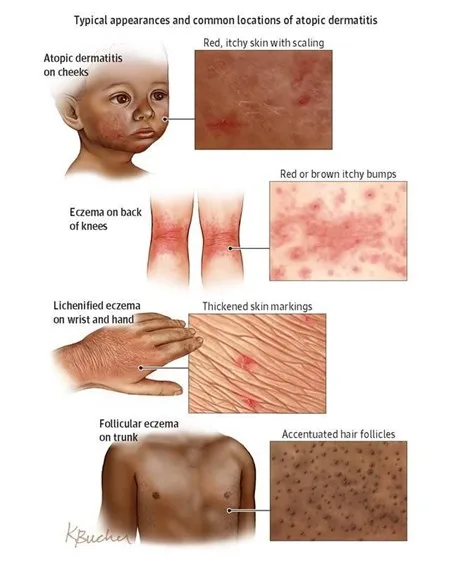 Signs And Symptoms Of Atopic Dermatitis A