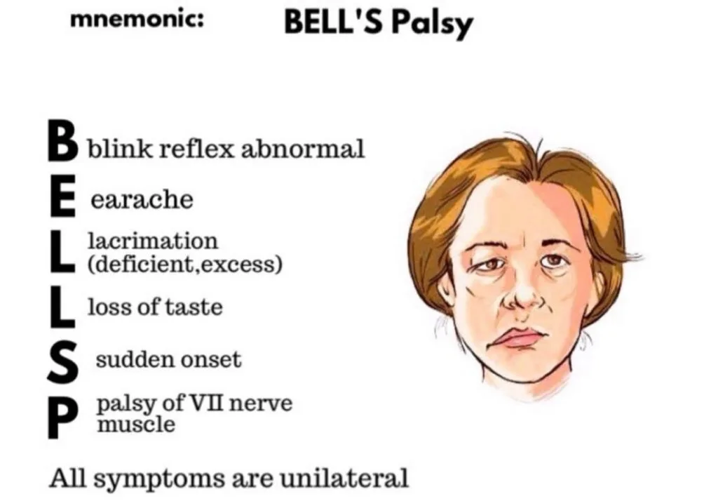 Signs And Symptoms Of Bells Palsy 1 E1742449443130