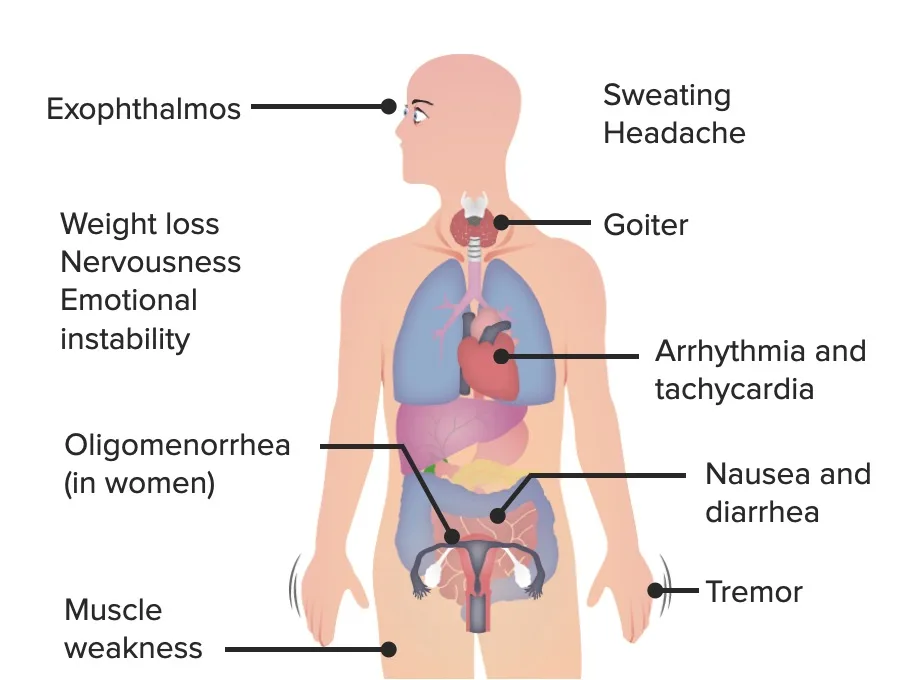 Signs And Symptoms Of Thyrotoxicosis