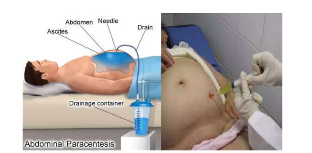 Sites And Positioning Of Patients For Abdominal Paracentesis E1719384396955