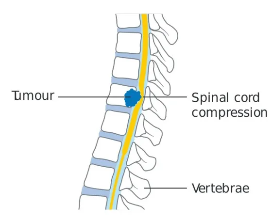 Spinal Cord Compression