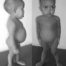 Spondyloepiphyseal Dysplasia Congenita