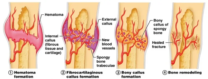 Stages Of Bone Healing