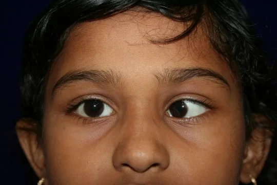 Strabismus