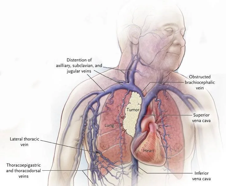 Superior Vena Cava Obstruction SVCO