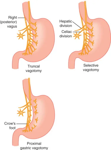 Surgical Management Peptic Ulcers